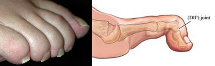 Mallet toe treatments are available at FootSmart Podiatry