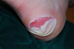 Cover blisters with a plaster or dry dressing to prevent infection