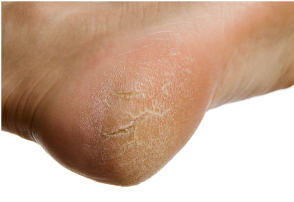 Cracked heels & hard skin feet fissures can be helped by moisturising
