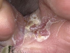 Fungal foot infection athletes foot between toes