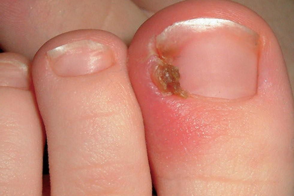 Treating Ingrown Toenails Without Surgery Or Pain - Sole Motion Podiatry
